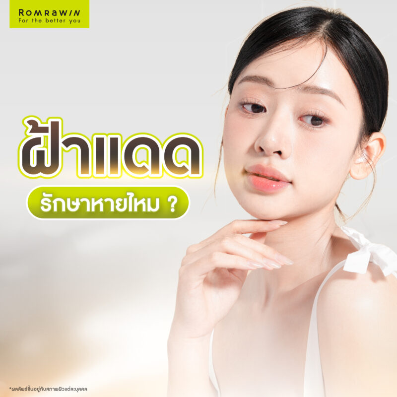 ฝ้าแดดรักษาหายไหม ?